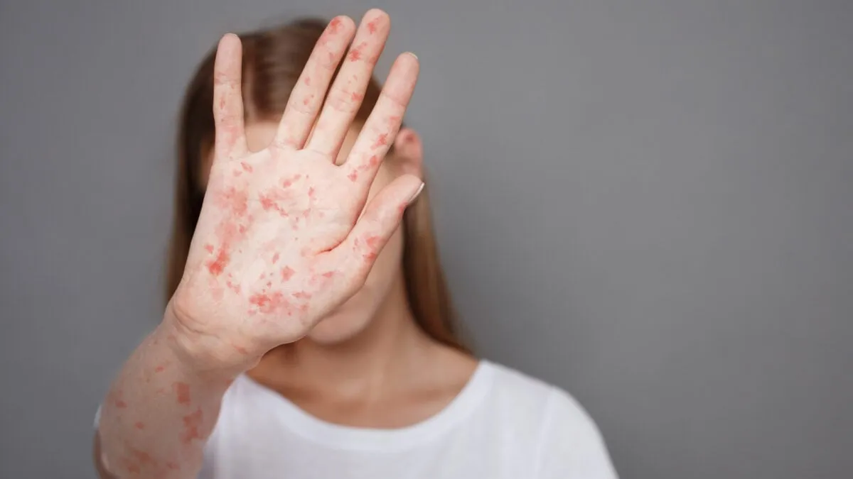 America's Measles Crisis: Record High Cases and New Threats Emerge