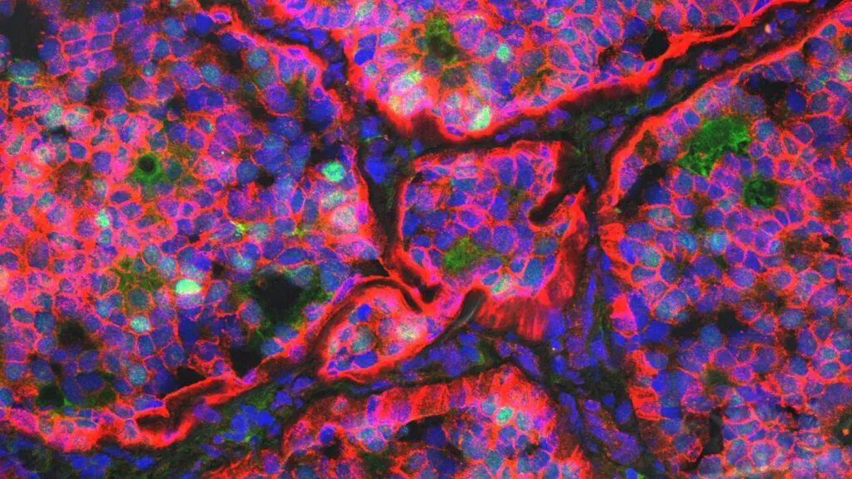 Breakthrough Cancer Treatment Shows Promise for Aggressive Breast Cancer