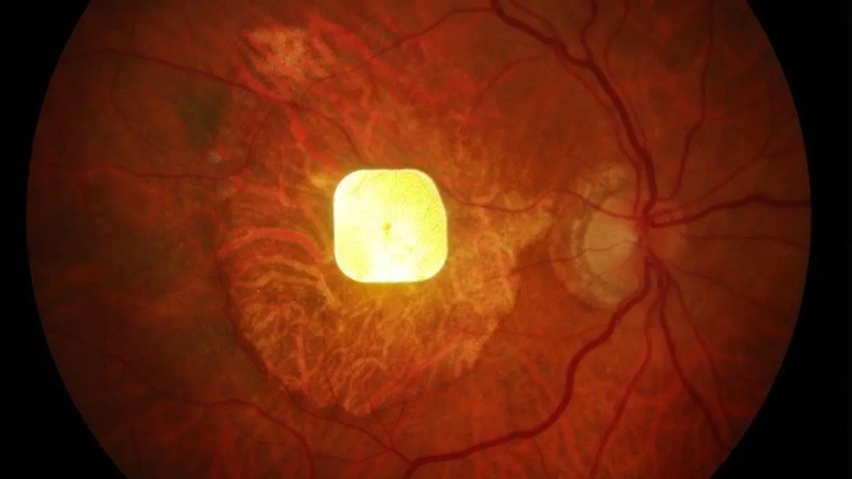 Breakthrough Chip Restores Vision for Patients with Age-Related Macular Degeneration