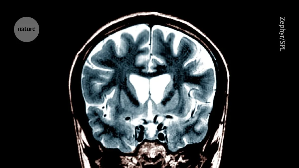 Breakthrough Gene Therapy Slows Huntington’s Disease Progression by 75%