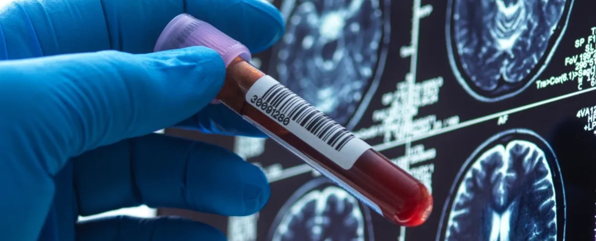 Breakthroughs in Alzheimer's Treatment: New Drugs and Blood Tests Offer Hope