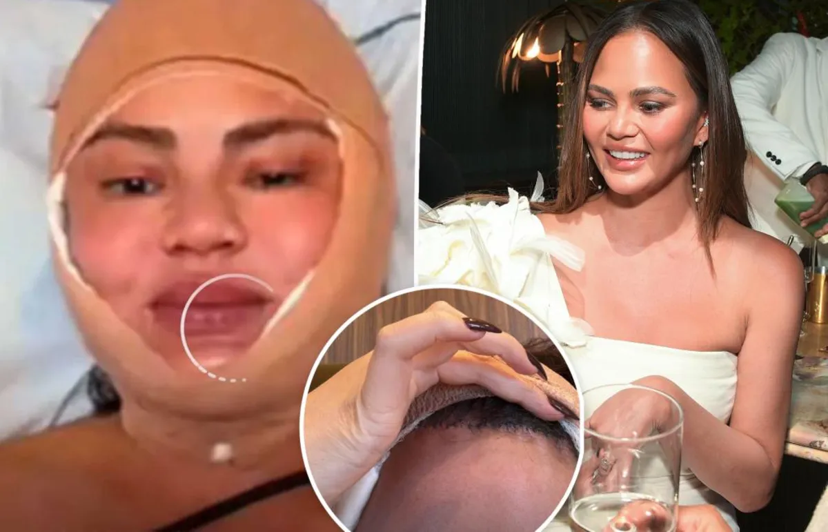 Chrissy Teigen Reveals Hairline Surgery: A Bold Move for Confidence
