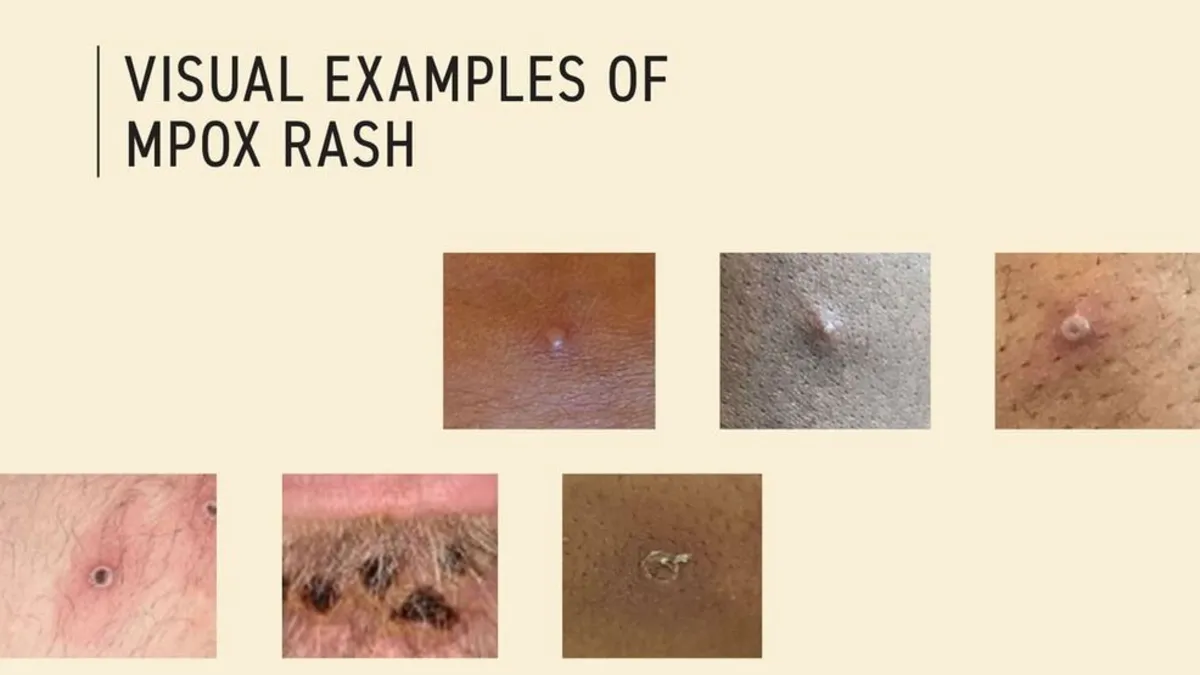 Clade I Mpox Detected in Pierce County Wastewater: What You Need to Know