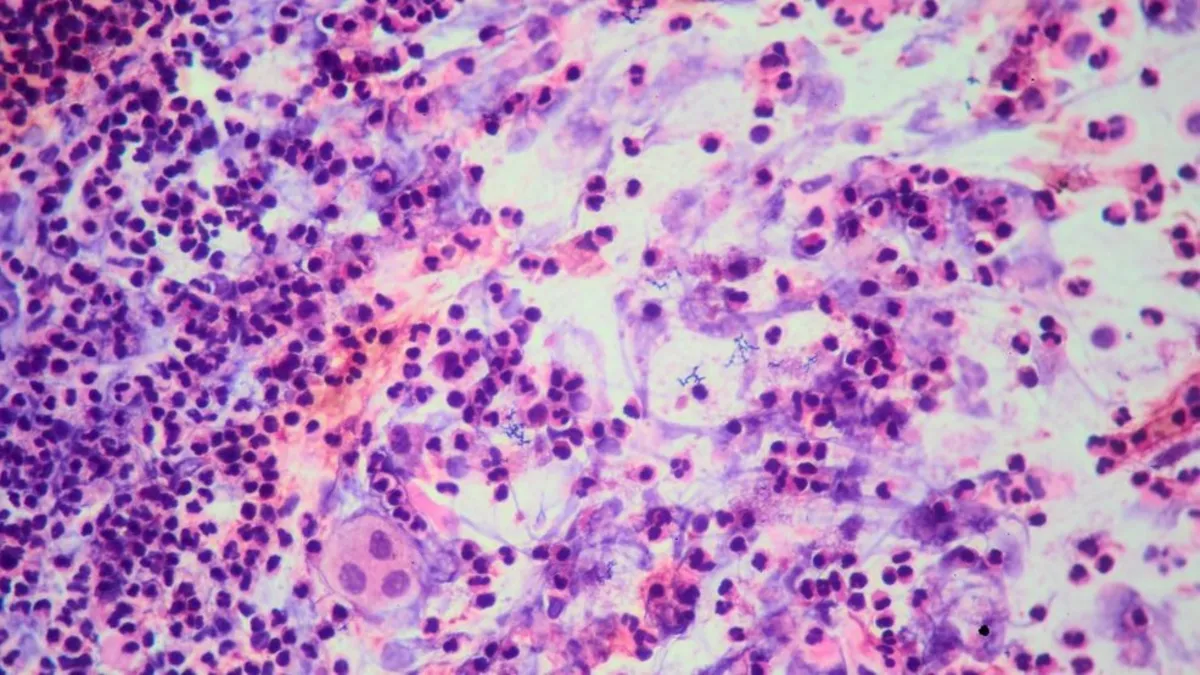 Coldwater High School Confirms Tuberculosis Case: What Parents Need to Know