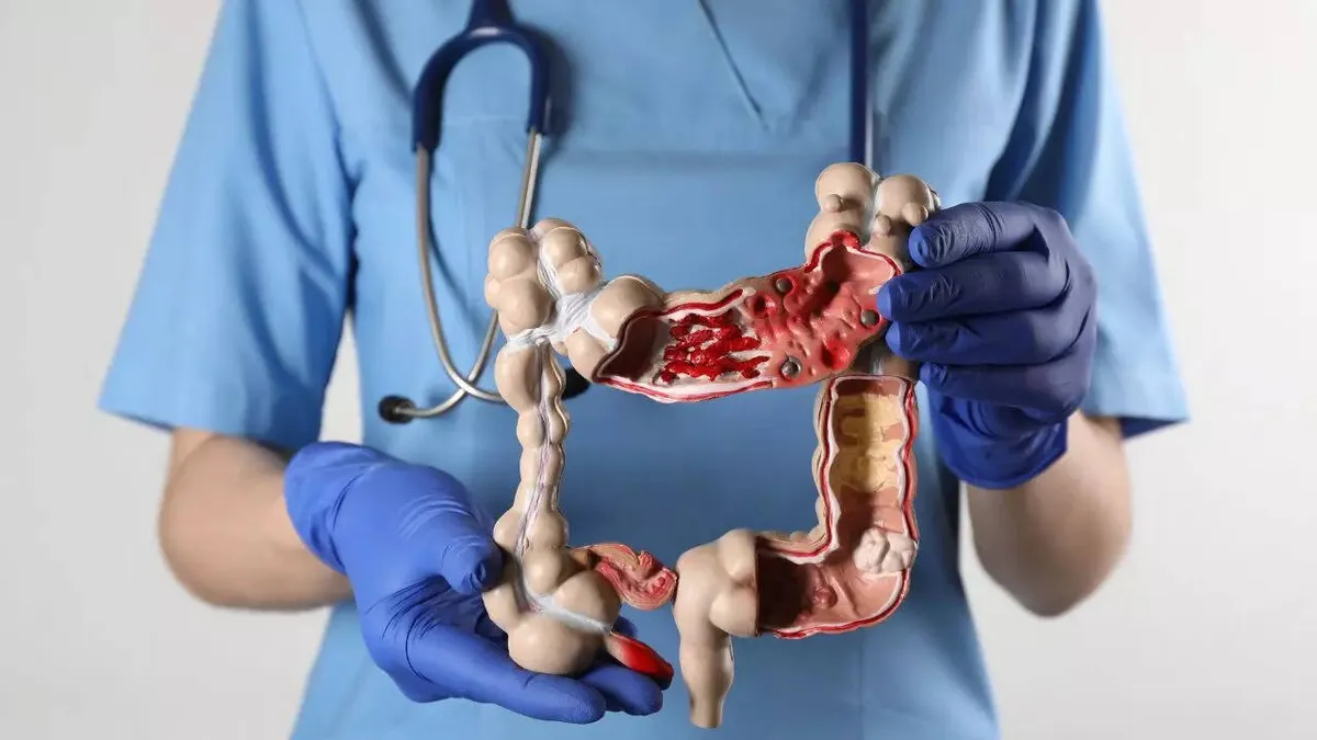 Colorectal Cancer Surge: Why Early Detection Could Save Your Life
