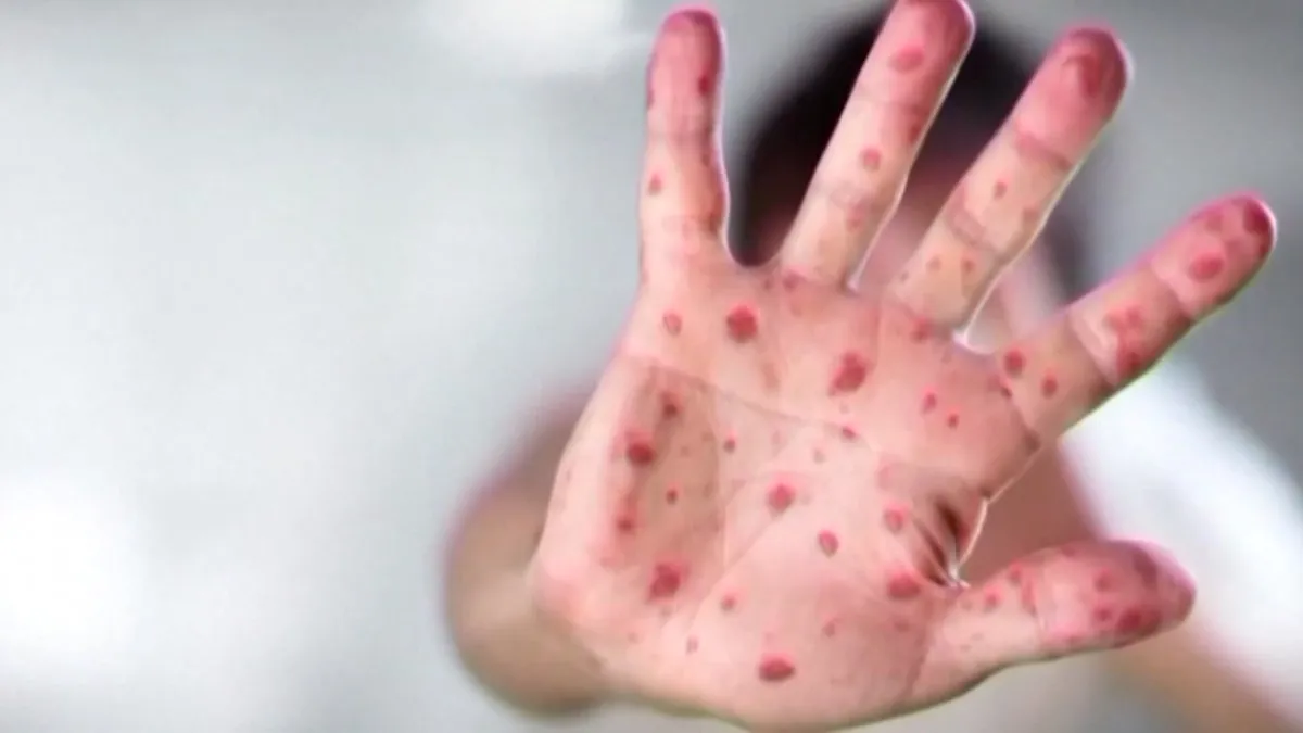 First Measles Case of 2025 Reported in Dallas County: What You Need to Know