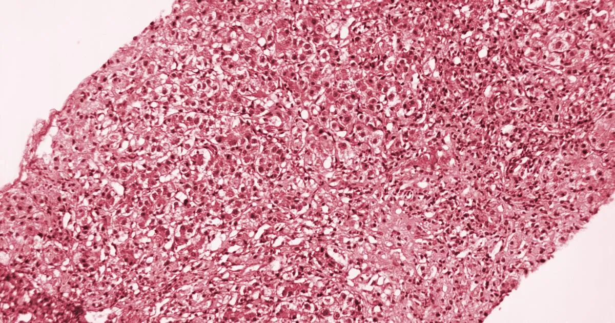 Hepatitis A Outbreak in L.A. County: Urgent Health Alert Issued