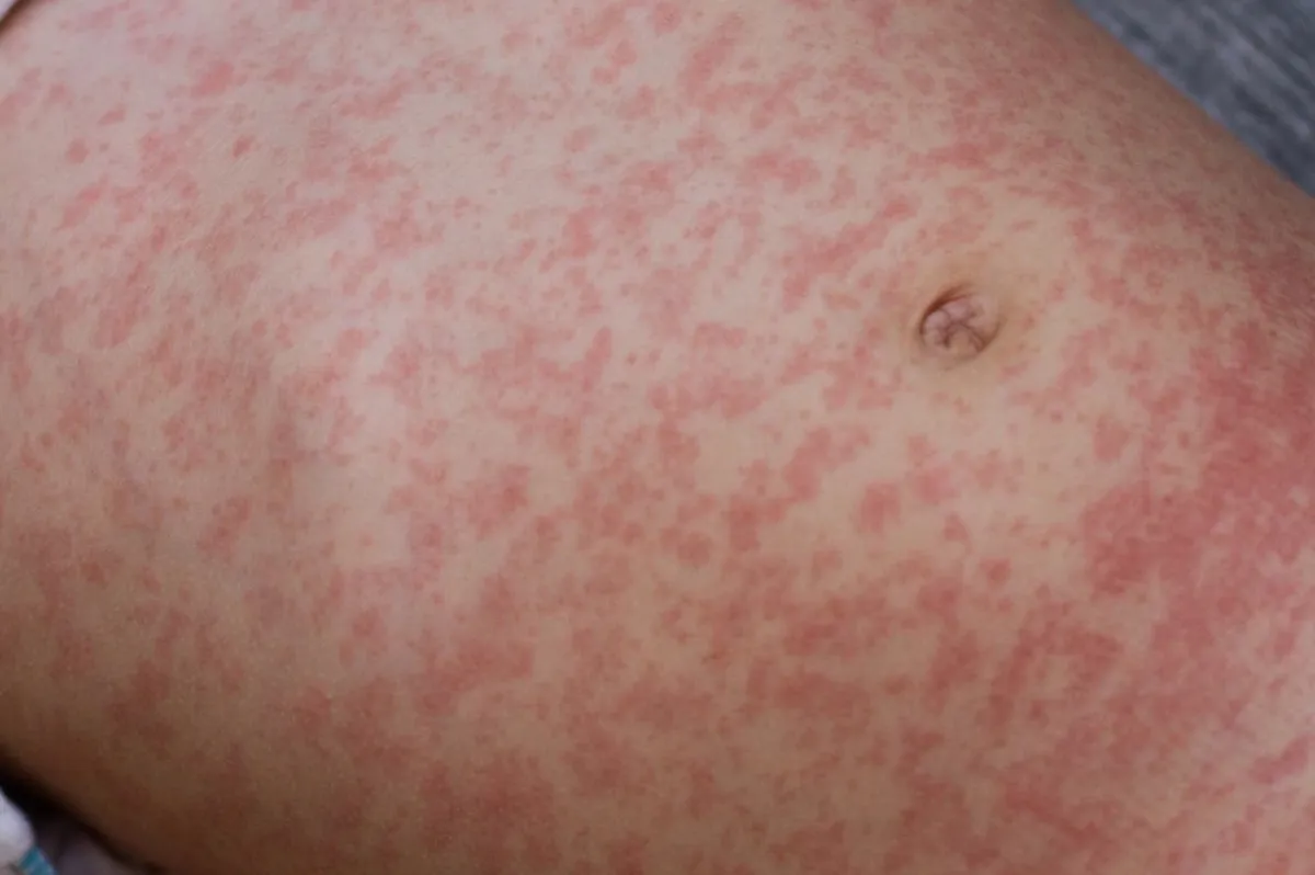 Measles Alert: Unvaccinated Child Linked to O'Hare Exposure