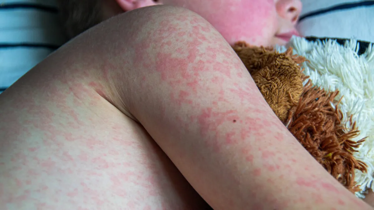 Measles Cases Surge to Record High: Is the US Losing Its Elimination Status?