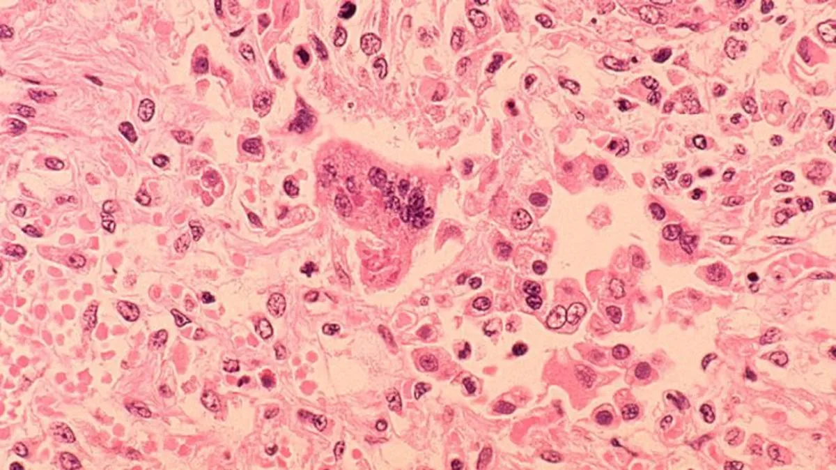 Measles Outbreak Sparks Quarantine for 200 Students in North Dakota