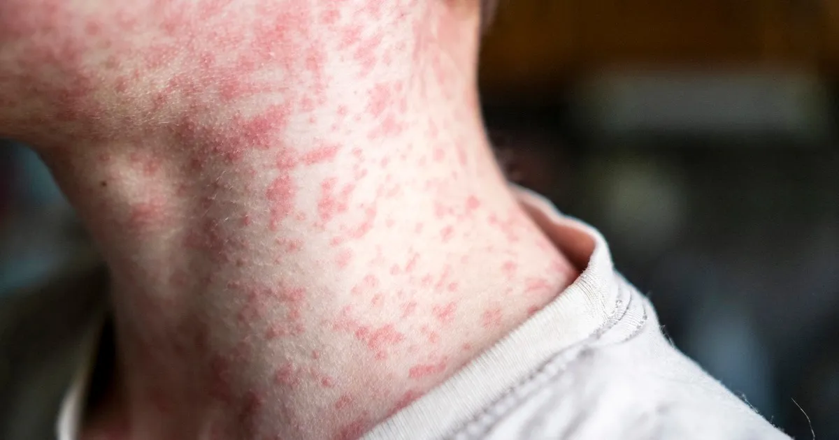 Measles Outbreaks Surge: Minnesota and Arizona on Alert!
