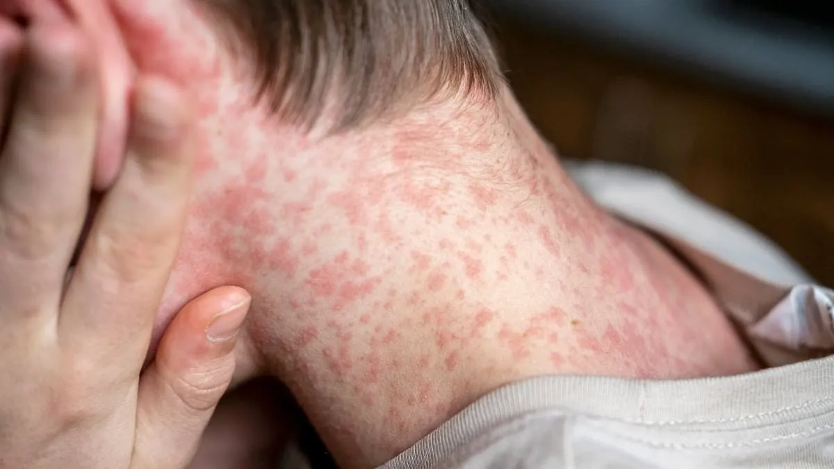 Measles Threatens US Children as Vaccination Rates Plummet