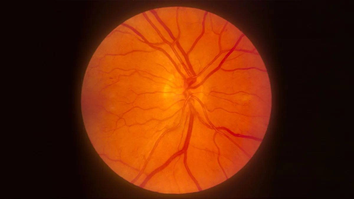 New Study Reveals Slight Increase in Diabetic Retinopathy Risk with GLP-1 Agonists