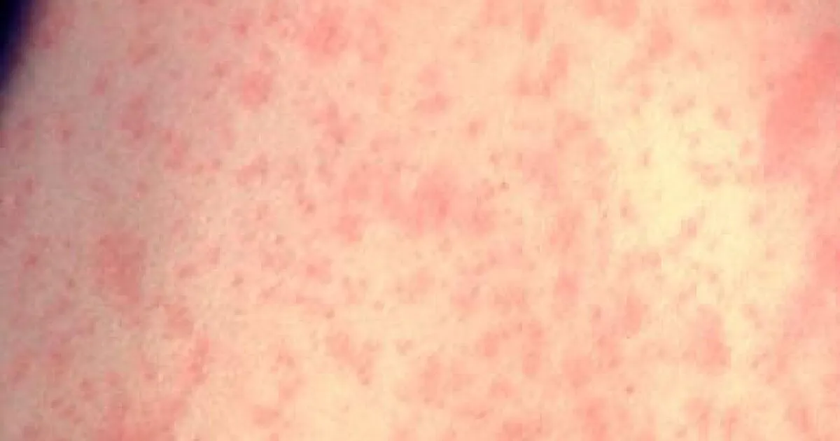North Dakota Faces Measles Outbreak After 14 Years: What You Need to Know