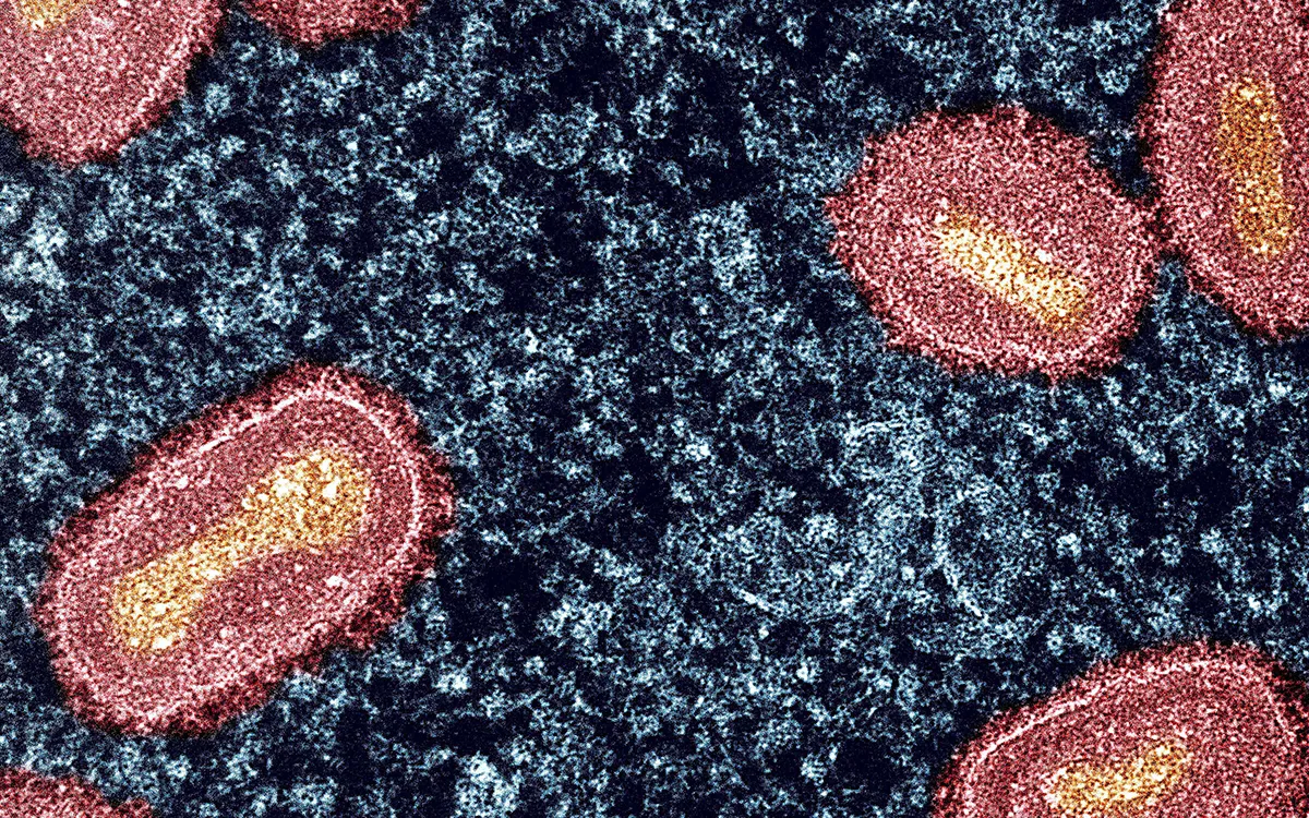 Rare Mpox Virus Strain Detected in Los Angeles: What You Need to Know