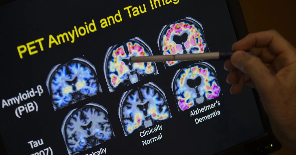 Revolutionary Blood Test for Alzheimer’s Disease Set to Launch in the U.S.