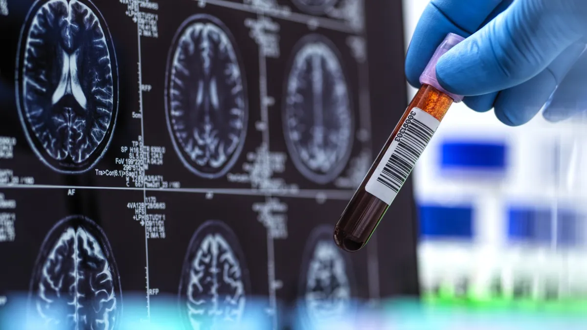 Revolutionary Blood Test Set to Transform Alzheimer's Diagnosis