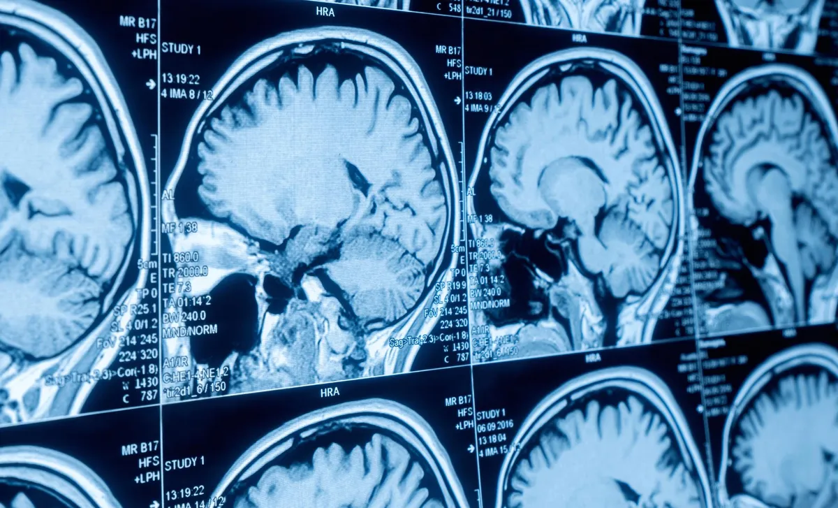 Revolutionary New Treatment Offers Hope for Treatment-Resistant Depression