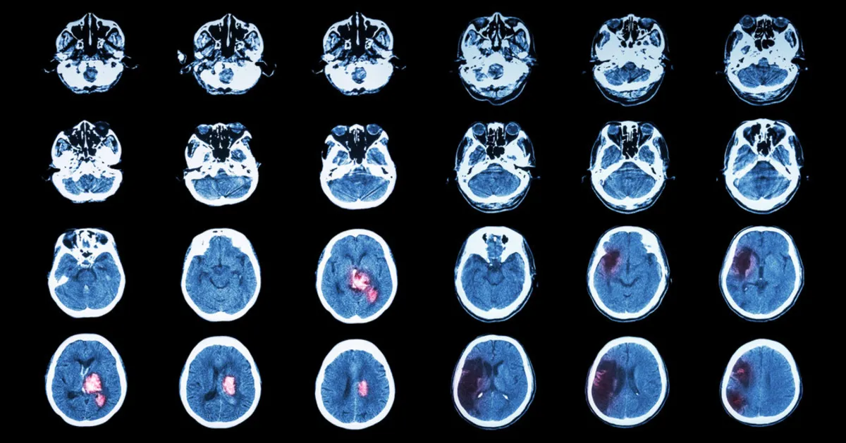 Revolutionizing Stroke Recovery: New Hope for Healing the Brain