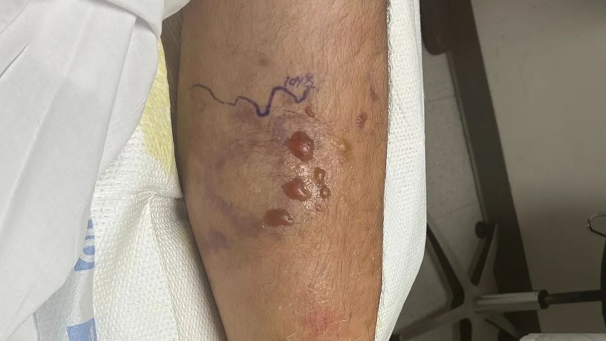 Rising Threat: Flesh-Eating Bacteria Claims Fifth Victim in Louisiana