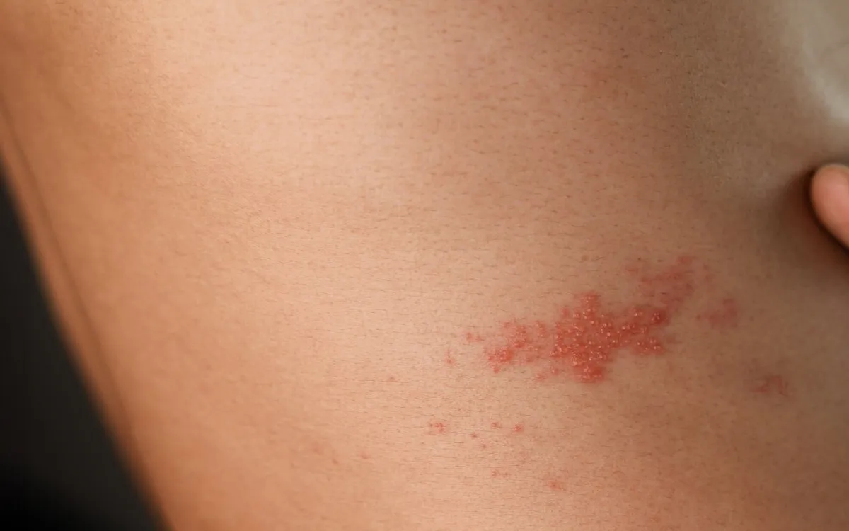 Shingles Vaccine Linked to Lower Heart Attack and Stroke Risk: New Research Reveals