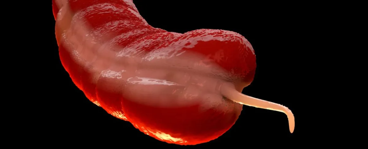 The Alarming Rise of Appendix Cancer: What You Need to Know