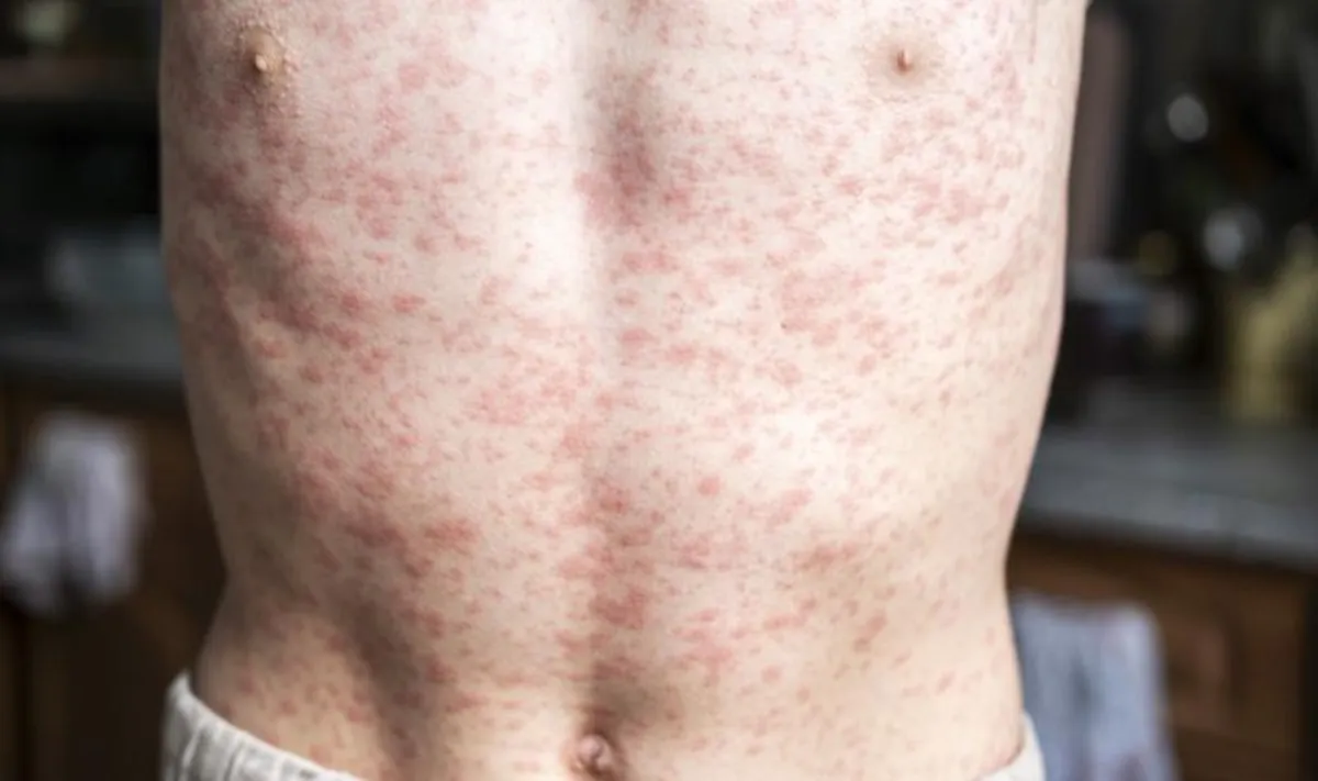 Upstate South Carolina Measles Outbreak Grows: 25 Cases Reported