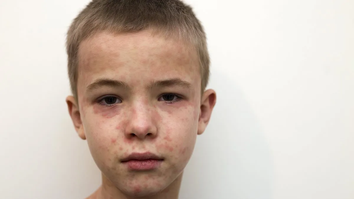 Urgent Warning: Measles Threat Looms After Outbreak in Multiple States