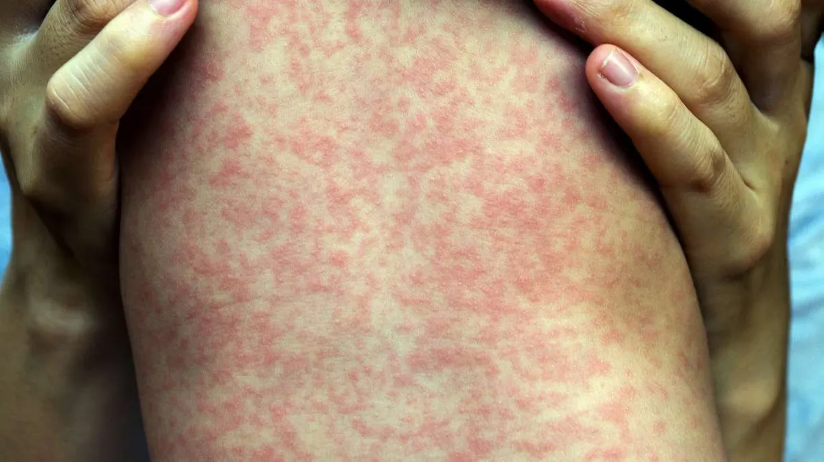 Utah Sees Spike in Measles Cases: What You Need to Know